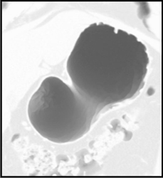 Normal Stomach With Air - CTisus CT Scan