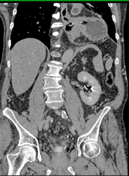 Para-esophageal Hiatal Hernia - CTisus CT Scan