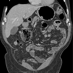 GIST Tumor - CTisus CT Scan