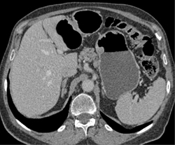 GIST Tumor - CTisus CT Scan