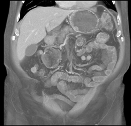 GIST Tumor - CTisus CT Scan