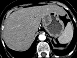 GIST Tumor With Ulceration - CTisus CT Scan