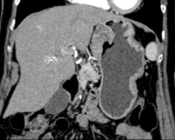 GIST Tumor With Ulceration - CTisus CT Scan