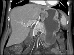 GIST Tumor With Ulceration - CTisus CT Scan