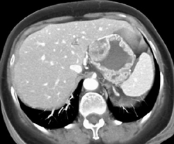 GIST Tumor With Ulceration - CTisus CT Scan