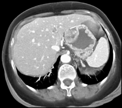 GIST Tumor With Ulceration - CTisus CT Scan