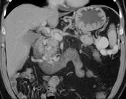 Collaterals Near Antrum Due to Celiac Stenosis - CTisus CT Scan