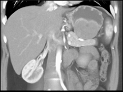 GIST Tumor With Ulceration - CTisus CT Scan