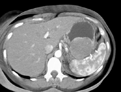 GIST Tumor With Ulceration - CTisus CT Scan