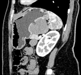 GIST Tumor With Ulceration - CTisus CT Scan