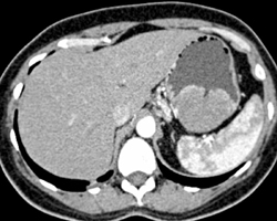 GIST Tumor With Ulceration - CTisus CT Scan