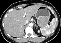 GIST Tumor With Ulceration - CTisus CT Scan