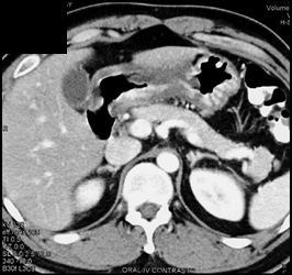 Gastritis Simulates Gastric Adenocarcinoma - CTisus CT Scan