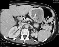 Hematoma in Stomach - CTisus CT Scan