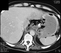 Mucormycosis Invades the Stomach - CTisus CT Scan