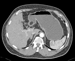 Antral Lipoma - CTisus CT Scan