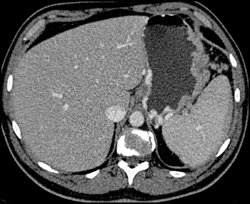 Gastric Varices Simulate Gastric Cancer - CTisus CT Scan