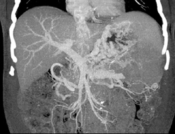 Gastric Varices - CTisus CT Scan