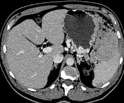 Gastric Varices - CTisus CT Scan