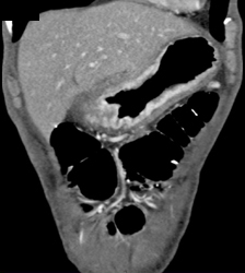 Gastric Adenocarcinoma - CTisus CT Scan