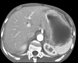 Gastric Adenocarcinoma - CTisus CT Scan