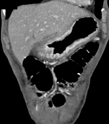 Gastric Adenocarcinoma - CTisus CT Scan