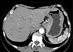 Gastric Adenocarcinoma - CTisus CT Scan