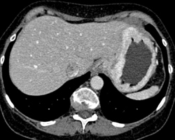 Gastric Adenocarcinoma - CTisus CT Scan