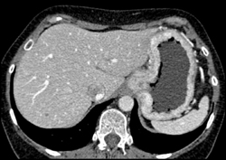 Gastric Adenocarcinoma - CTisus CT Scan