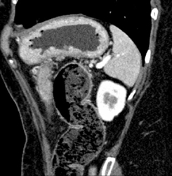 Gastric Adenocarcinoma - CTisus CT Scan