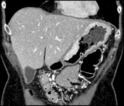 Gastric Adenocarcinoma - CTisus CT Scan