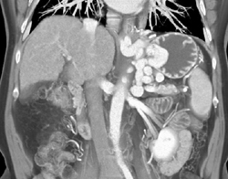 Gastric Varices - CTisus CT Scan