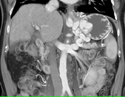 Gastric Varices - CTisus CT Scan