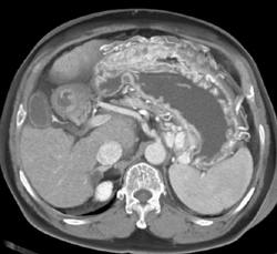 Gastric Varices - CTisus CT Scan