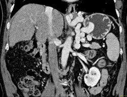 Gastric Varices - CTisus CT Scan