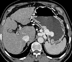 Gastric Varices - CTisus CT Scan