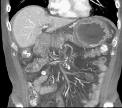 Infiltrating Gastric Cancer With Early Carcinomatosis - CTisus CT Scan