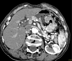 Gastric Adenocarcinoma - CTisus CT Scan