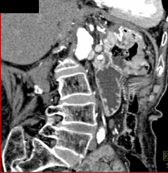 Gastric Adenocarcinoma - CTisus CT Scan