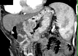 Gastric Adenocarcinoma - CTisus CT Scan