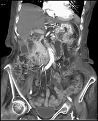 Gastric Adenocarcinoma - CTisus CT Scan