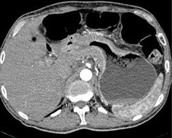 Gastric Adenocarcinoma - CTisus CT Scan