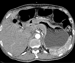 Gastric Adenocarcinoma - CTisus CT Scan