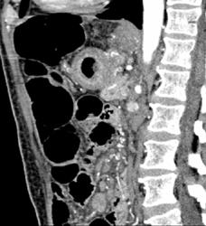 Gastric Adenocarcinoma - CTisus CT Scan