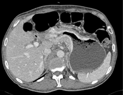 Gastric Adenocarcinoma - CTisus CT Scan