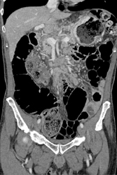 Gastric Adenocarcinoma - CTisus CT Scan