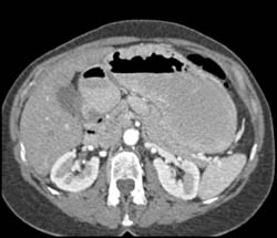 Gastric Adenocarcinoma Antrum - CTisus CT Scan