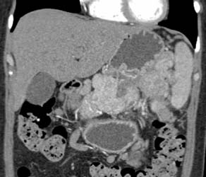 Gastric Varices Due to Portal Vein and Splenic Vein Occlusion By Islet Cell Carcinoma of the Pancreas - CTisus CT Scan