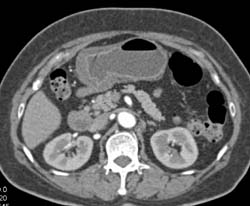 Gastric Adenocarcinoma - CTisus CT Scan