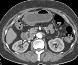 Gastric Adenocarcinoma - CTisus CT Scan